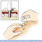 皮膚取樣器（皮膚環(huán)鉆,Skin Biopsy Punches）
